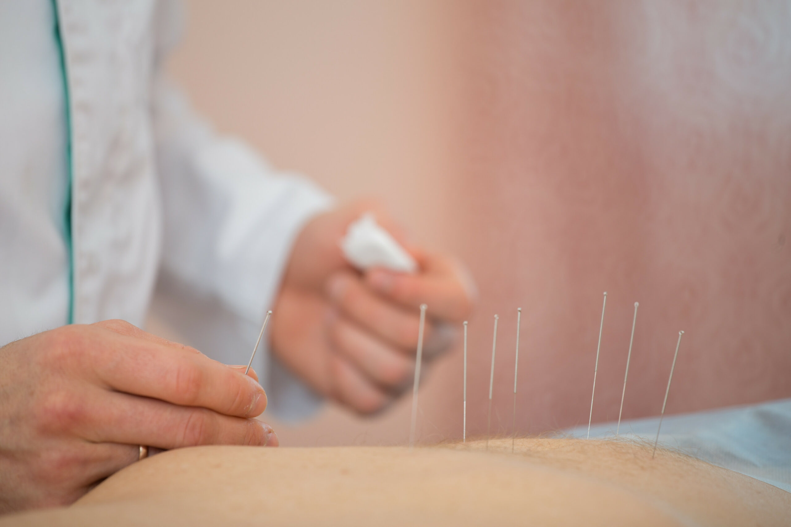 Photo of acupuncture treatments, placement of medical needles on the patient, close-ups