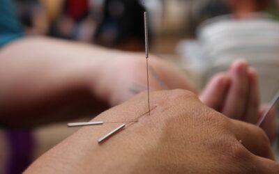 Carpal Tunnel Syndrome (CTS) and Acupuncture