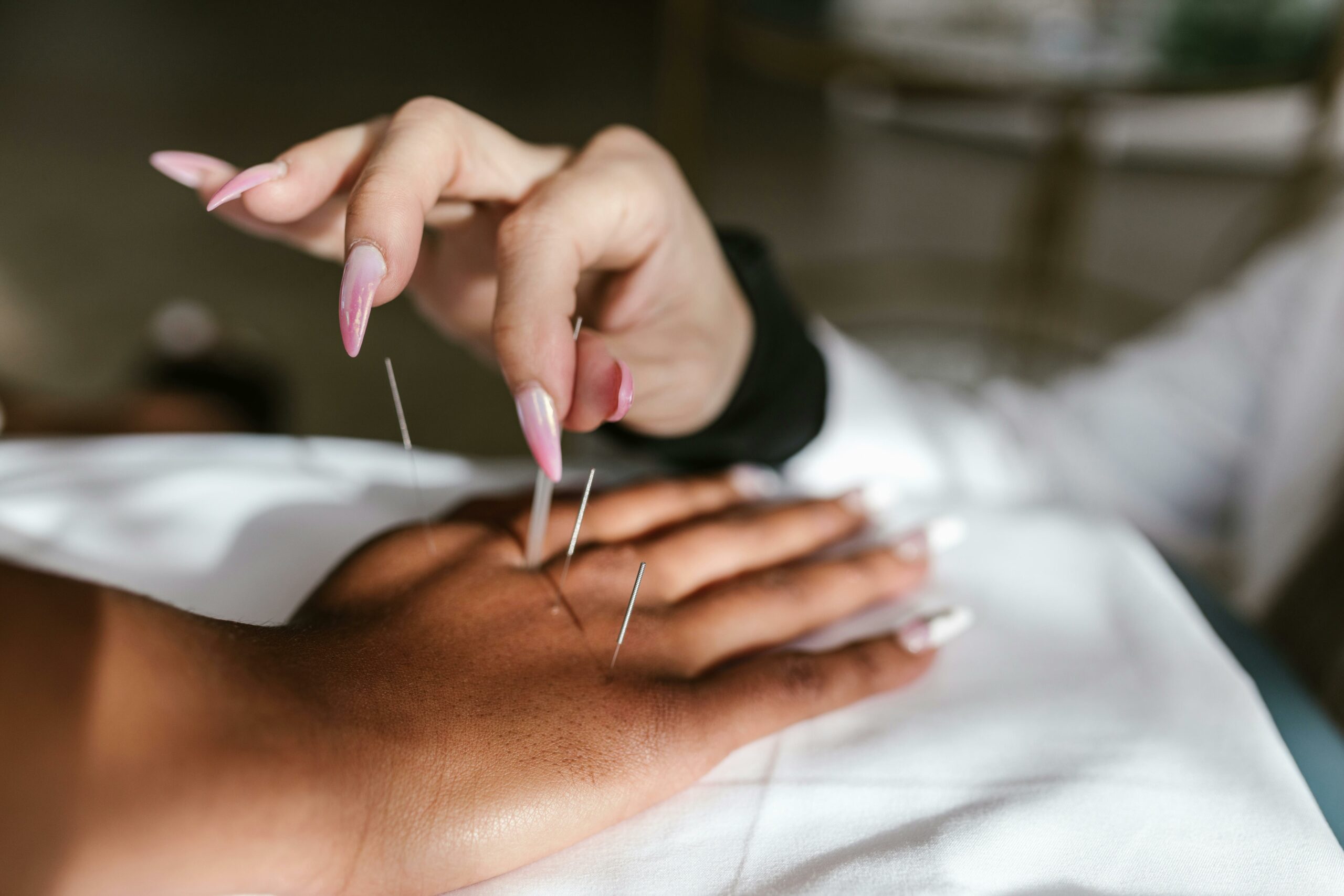 How Regular Acupuncture Sessions Can Improve Quality of Life for Fibromyalgia Patients