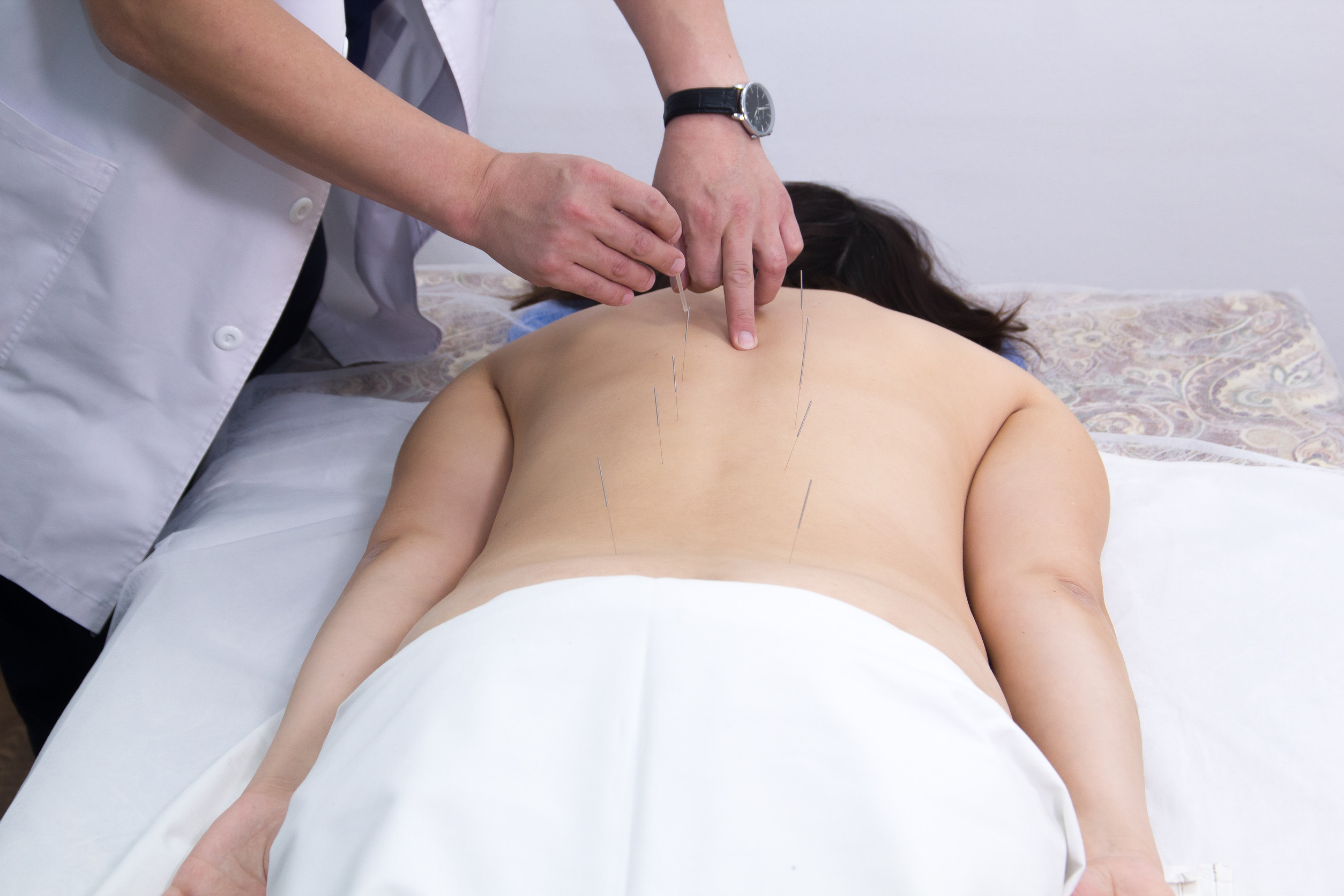 An acupuncturist inserting thin needles into the back of a patient lying face down on a treatment table, partially covered with a white sheet.