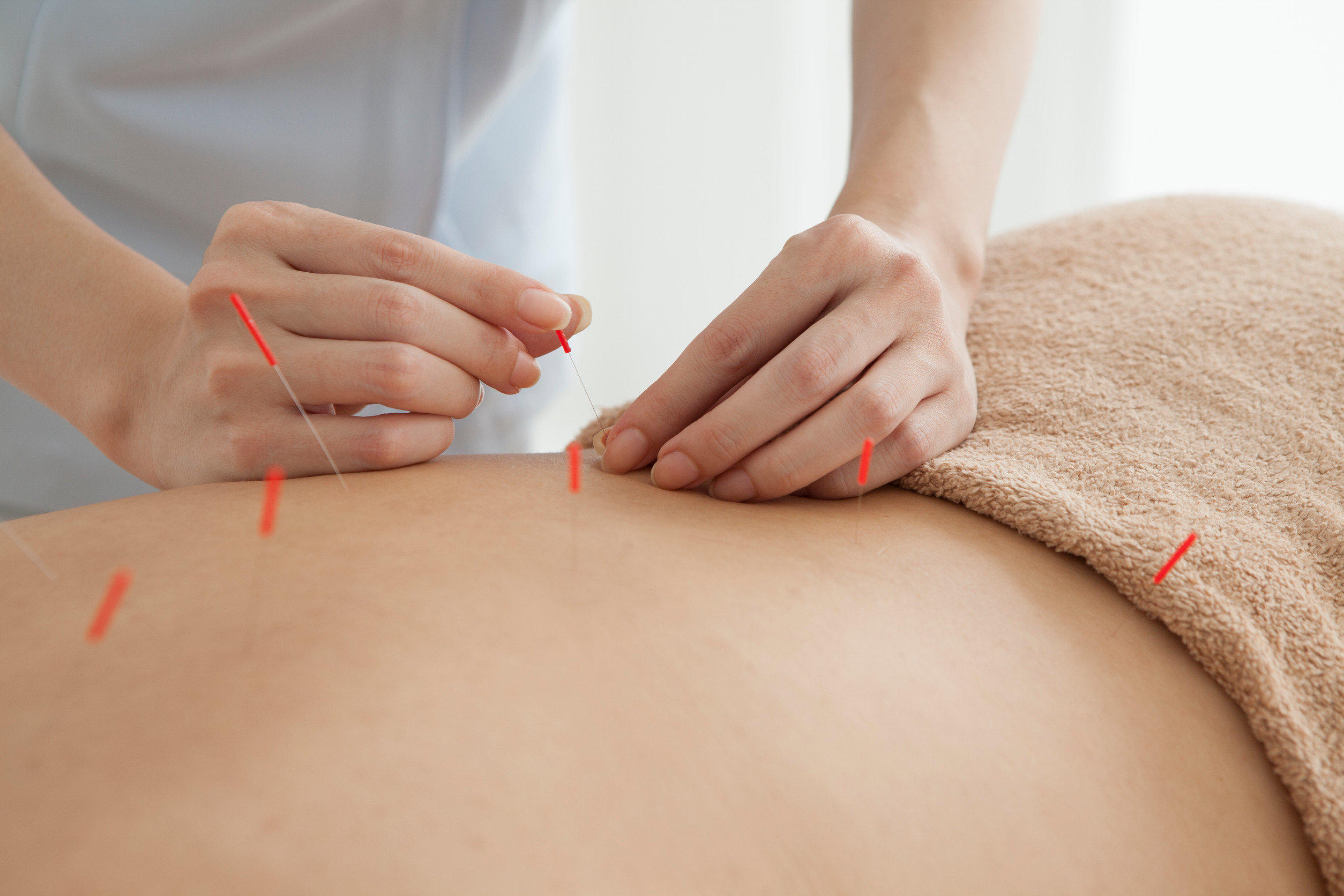 Close-up of hands performing acupuncture on a person's back, with several fine needles inserted into the skin, covered partially by a beige towel.