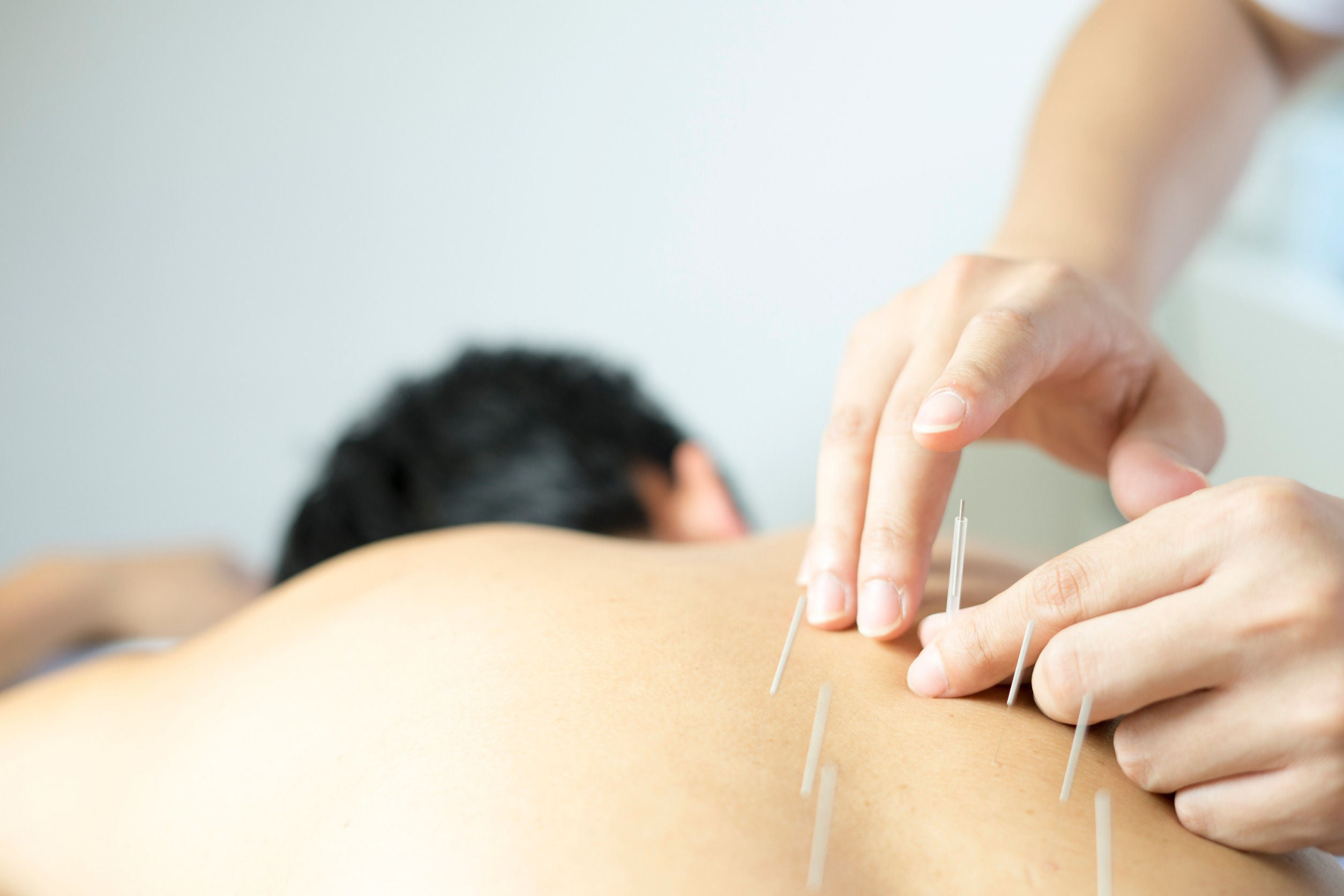 A close-up of an acupuncture for pain relief where a practitioner carefully inserts thin needles into a patient's back, showcasing the precision and technique of this traditional Chinese medical practice in a calm, clinical environment.