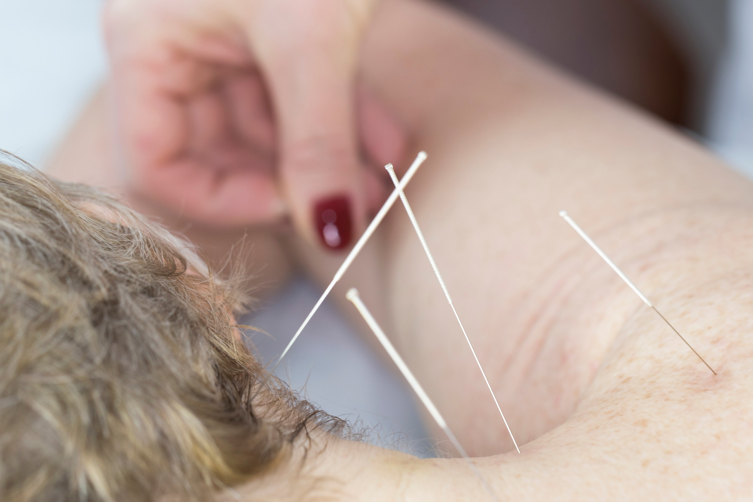 A close-up image of an acupuncture session, with a practitioner delicately inserting thin needles into a patient's shoulder area. The scene highlights the precision and care involved in this therapeutic practice, creating a sense of relaxation and healing.