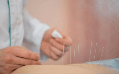 What Can You Expect From Acupuncture for Pain Relief in Albuquerque?